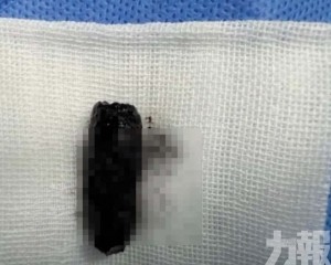 鼻腔取出藏40年螺絲