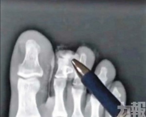 穿人字拖踢中石頭腳趾飛脫