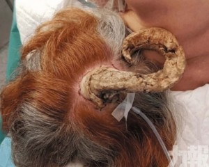 親友疑邪靈附身 醫揭竟是皮膚癌