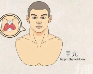 甲亢真的是終身不能治癒嗎？