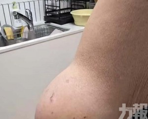 巨大脂肪瘤影響日常生活，醫生提醒：皮下腫塊持續增大應及早求診