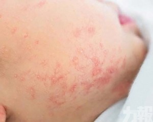 悶熱天氣下的常見兒童皮膚疾病及處理