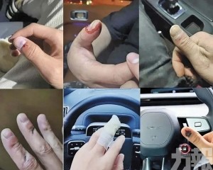 有人被夾到手指骨折