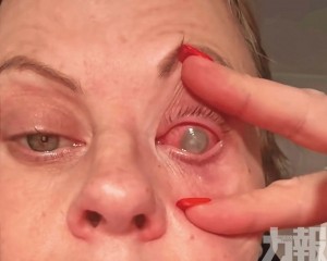 染罕見寄生蟲右眼失明