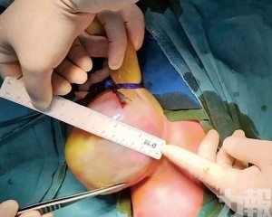 武漢醫生兩年分階段助器官歸位