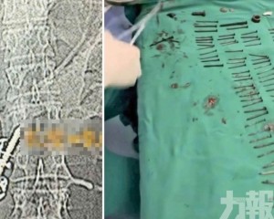 胃內竟取出180顆鐵釘