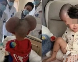 手術移除後終於笑了
