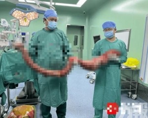 手術取出逾10公斤「巨蟒」