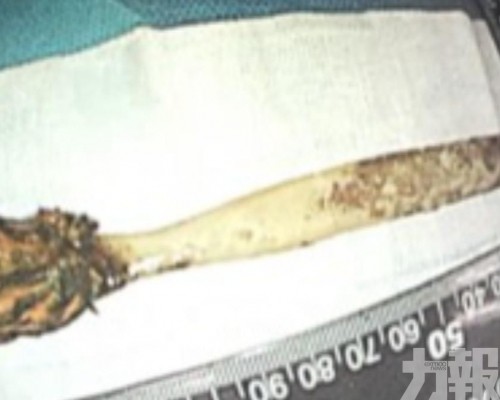 卡腸道52年終取出