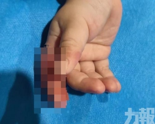 女嬰手指部分皮膚壞死險截肢