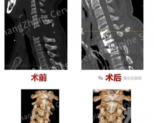 上海長征醫院團隊創醫學奇蹟