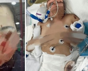 被打至直腸破裂臟器損傷身亡