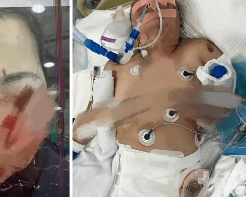 被打至直腸破裂臟器損傷身亡