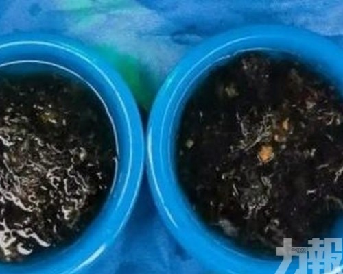確診罕見「長髮公主綜合症」