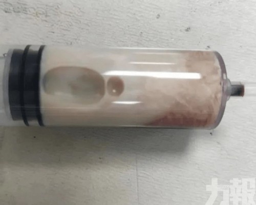 醫生從體內抽出「牛奶血」