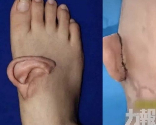 五個月後成功回植復位