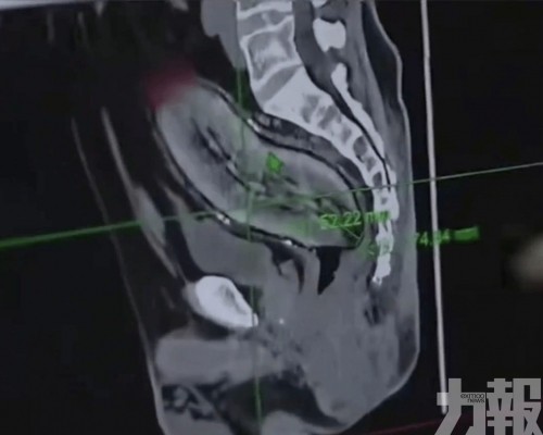 61歲男劇痛難忍送院開腹