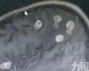  六歲女童腦部現20多個空洞