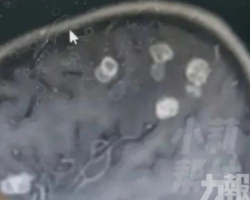  六歲女童腦部現20多個空洞