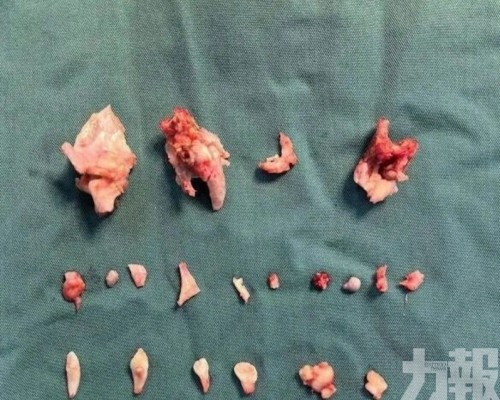 腹內畸胎瘤內藏24顆牙齒