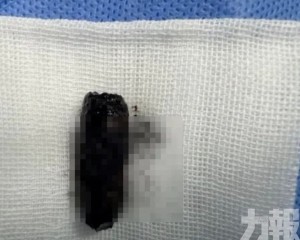 鼻腔取出藏40年螺絲