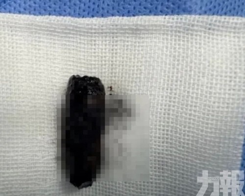 鼻腔取出藏40年螺絲