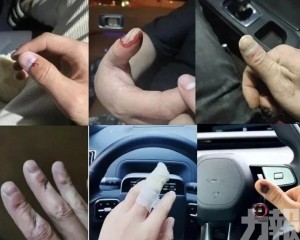 有人被夾到手指骨折