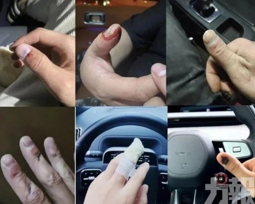 有人被夾到手指骨折
