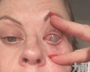 染罕見寄生蟲右眼失明
