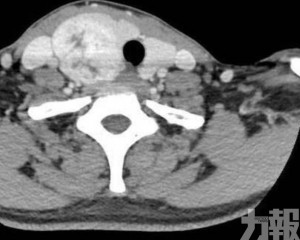 肺癌仍是癌症死亡之首